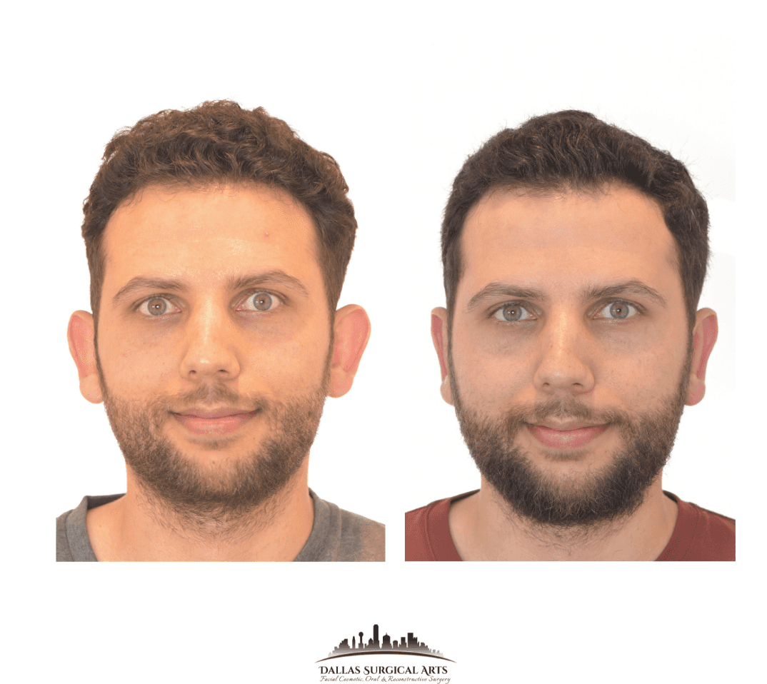 Dallas Otoplasty Surgeon Dr Randy Sanovich Dallas Surgical Arts Ear Surgery