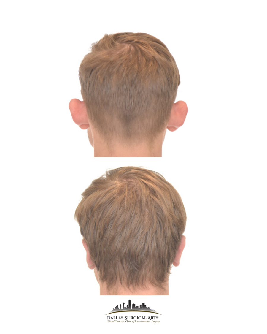 Dallas Otoplasty Surgeon Dr Randy Sanovich Dallas Surgical Arts