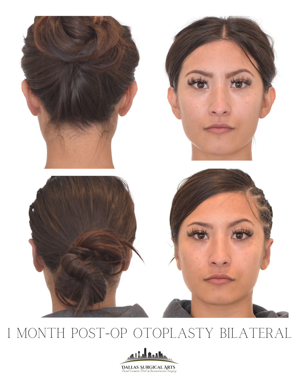 Dallas Otoplasty Surgeon Dr Randy Sanovich Dallas Surgical Arts Ear Surgery