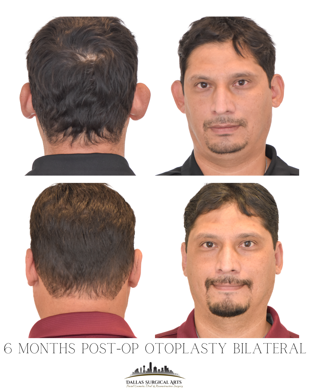 Dallas Otoplasty Surgeon Dr Randy Sanovich Dallas Surgical Arts Ear Surgery
