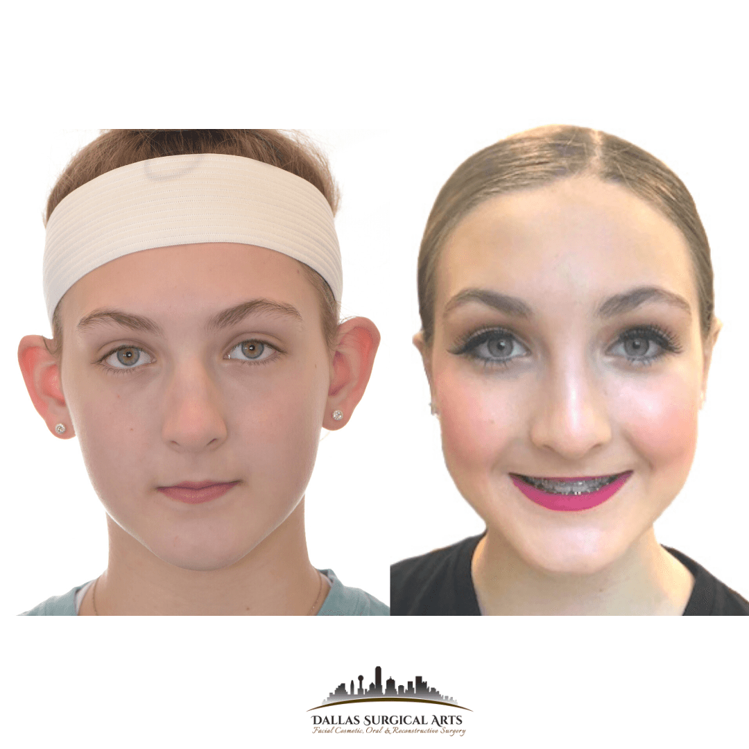 Dallas Otoplasty Surgeon Dr Randy Sanovich Dallas Surgical Arts Ear Surgery